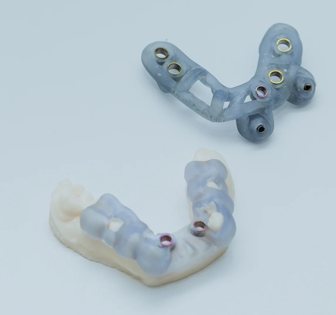 Impresión dental 3D en Bilbao